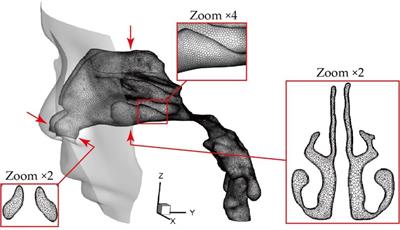 Numerical modelling of micron particle inhalation in a realistic nasal airway with pediatric adenoid hypertrophy: A virtual comparison between pre- and postoperative models